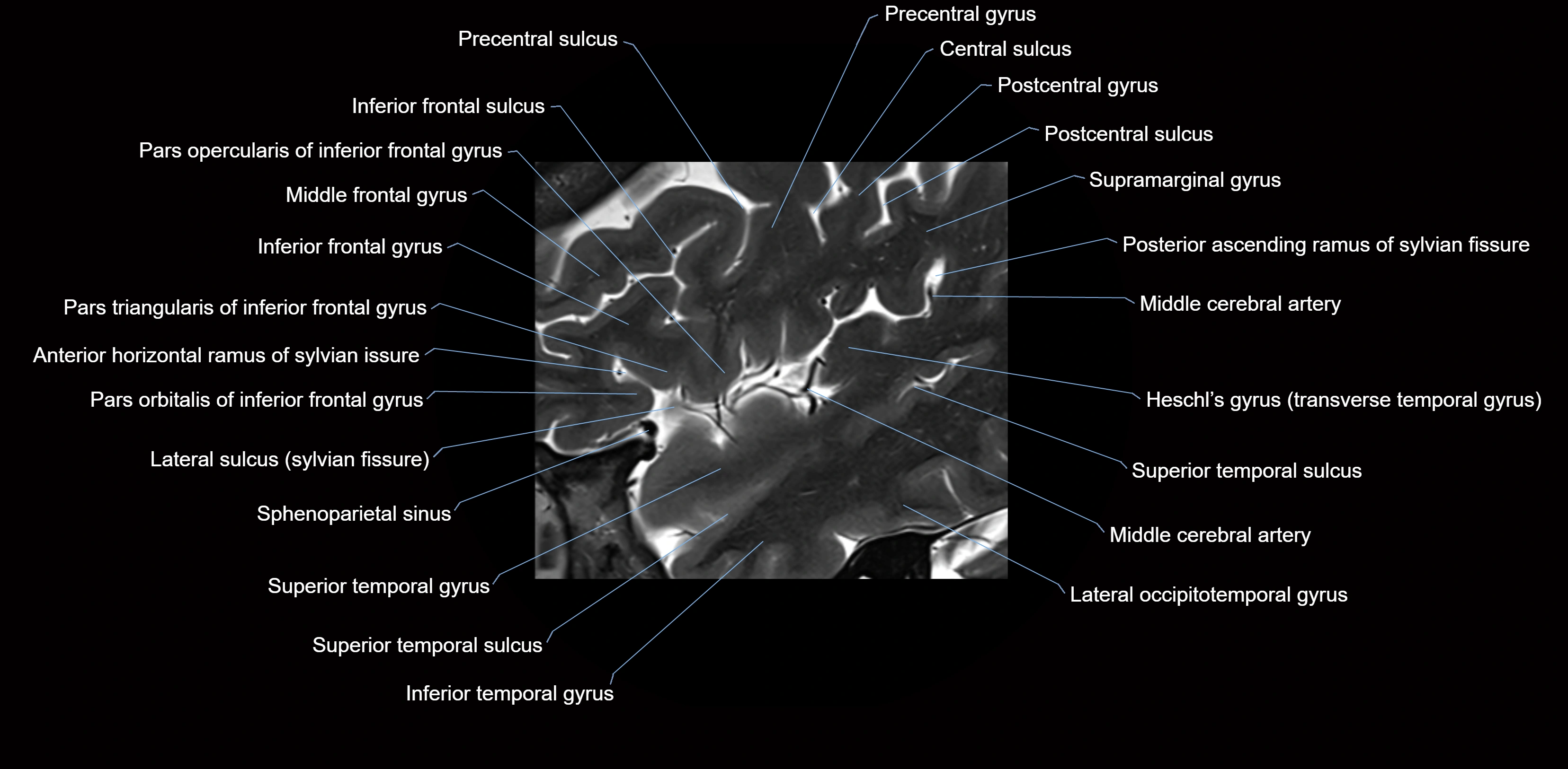 Insula cross section anatomy MRI sagittal 3t labelled image-img-00003.webp